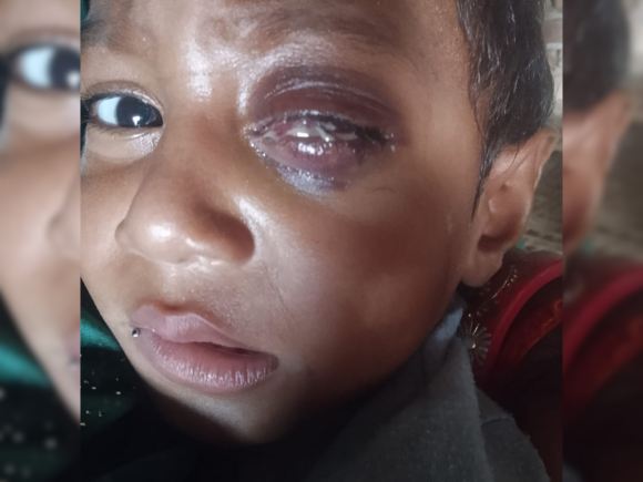 Help 2-Year-Old Kishore Fight Eye Cancer – Your Donation Can Save His Life